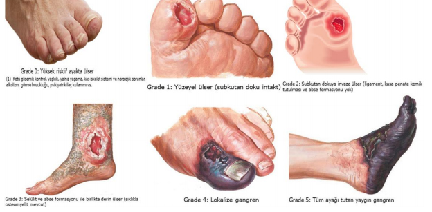 Diyabetik Ayak
